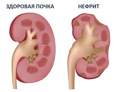 Nefrit kasalligi sabablari va buyraklarni davolash