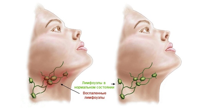 Limfa tugunlarining yallig'lanishi - Limfadenit